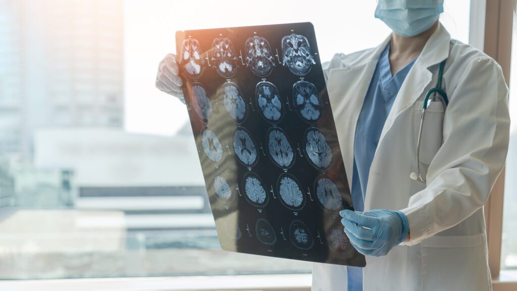 Brain disease diagnosis with medical doctor seeing Magnetic Resonance Imaging (MRI) film diagnosing elderly ageing patient neurodegenerative illness problem for neurological medical treatment