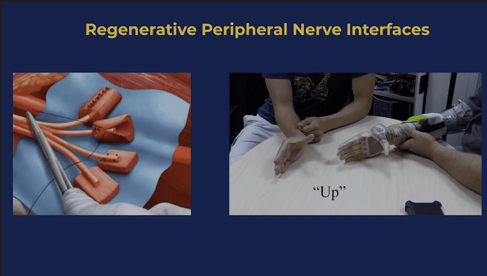 Illustration shows nerve surgery; adjacent image demonstrates control of a prosthetic hand using regenerative peripheral nerve interfaces.